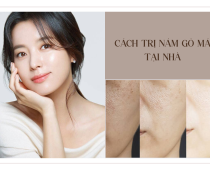 7 Cách Trị Nám Gò Má Tại Nhà Hiệu Quả Không Phải Ai Cũng Biết